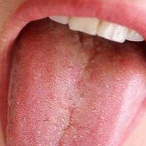 Coșurile de pe limbă sunt mai aproape de laringel: cosuri roșii
