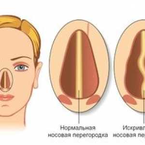 Repoziționarea oaselor din nas în fracturi