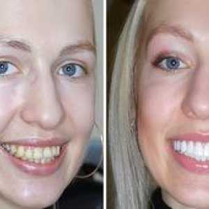 Restaurarea dinților: principalele tipuri și cât va costa