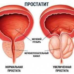 Cel mai eficient tratament al prostatitei cu remedii folclorice