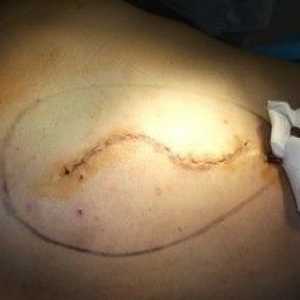 Seroma unei suturi chirurgicale pe cavitatea abdominală