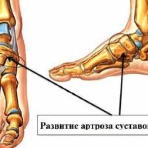Simptomele artrozei piciorului și a articulațiilor pe picior cu fotografii