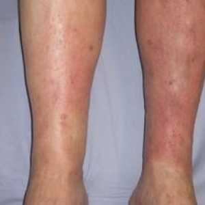 Simptomele și tratamentul dermatitei pe picioare, foto