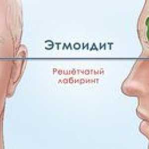 Simptomele și tratamentul etmoiditei și antritelor
