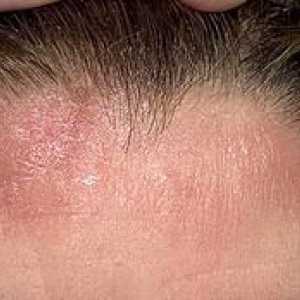 Simptomele și tratamentul dermatitei seboreice a scalpului