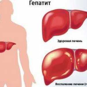Câți ani poate trăi o persoană când există hepatită cronică