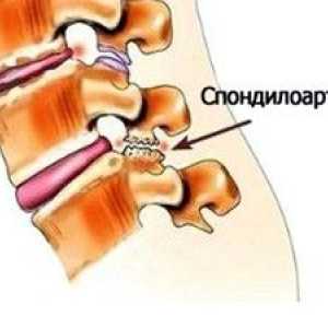Spondiloza coloanei vertebrale lombosacrale: tratament