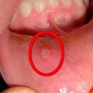 Stafilococul în gură: simptome, moduri de tratament, fotografie