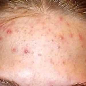 Erupțiile pe frunte ale unui adult: cauzele petelor roșii