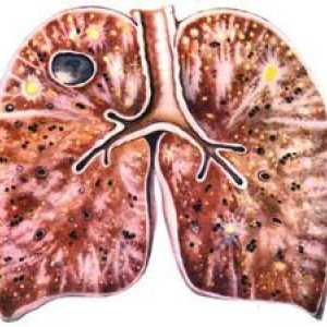 Tuberculoza: modul în care poate fi transmis, căile de transmisie și simptomele