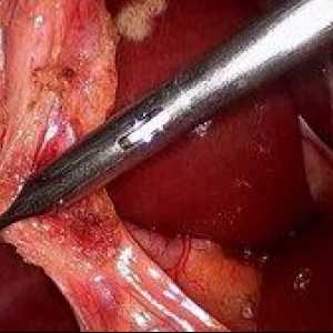 Îndepărtarea vezicii biliare: operații video laparoscopie