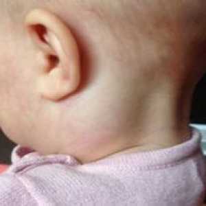 Noduri limfatice lărgite în gâtul copilului - motivele apariției