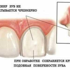 Furnizorii pe dinți: ce este, tipurile, descrierea și modul de a le pune