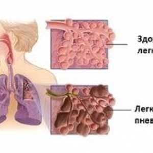 Totul despre fibroza pulmonară: cum se tratează modificările fibroase în plămâni