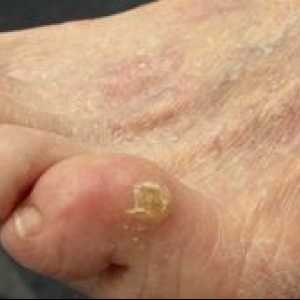 Boli ale tălpilor picioarelor: cum se vindecă calusele uscate