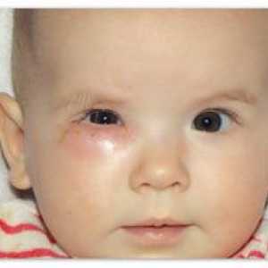 Ocluzia la nou-născuți a canalului lacrimal: cauze și tratament