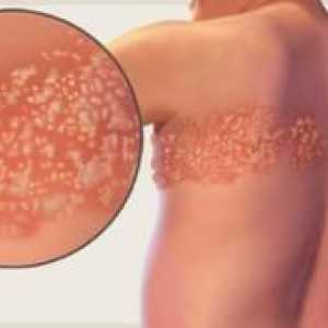 Familiarizarea cu herpes zoster: simptome și tratament