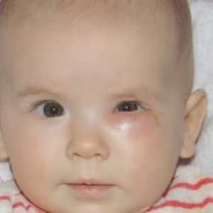 Verificarea canalului lacrimal la nou-născuți